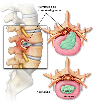 Slipped disc in malay